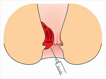 ジオン療法(ALTA療法)