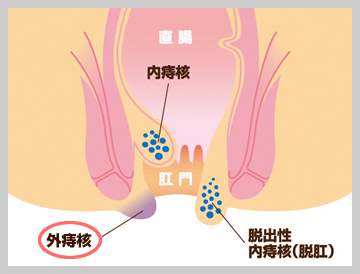 外痔核
