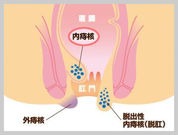 内痔核